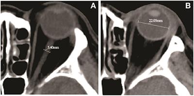 Optic nerve sheath diameter and optic nerve sheath diameter/eyeball transverse diameter ratio in prediction of malignant progression in ischemic stroke